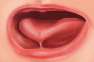 Tongue-Tie in Infants: Breastfeeding Woes and Surprising Causes